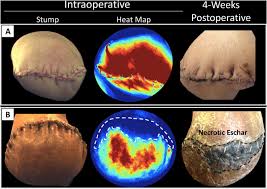 An eschar at the site of bite is pathognomic and the single most useful diagnostic clue. Amputation Stump Perfusion Is Predictive Of Post Operative Necrotic Eschar Formation The American Journal Of Surgery