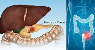Signs of pancreatic cancer are hard to spot, and early detection is key. 15 Facts And Symptoms Of Pancreatic Cancer You Should Never Ever Ignore