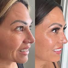 Natural Botox at home with only 2 ingredients Skin like a 30 year old, even  at 65 only polite members will say thank you for the recipe 😊 The recipe  in first comment 😊