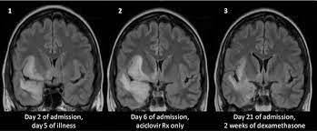 • restriction on diffusion weight mri = more sensitive than conventional sequences. Plos One A Feasibility Study Of Quantifying Longitudinal Brain Changes In Herpes Simplex Virus Hsv Encephalitis Using Magnetic Resonance Imaging Mri And Stereology