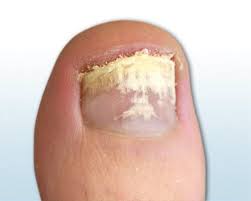 Nagelpilz Definition Erreger Symptome Bilder Ciclopoli