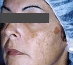 Chemical Peel