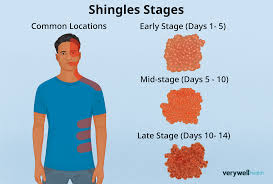 Image result for shingles