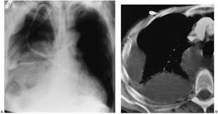 Learn about different types of pleural effusions, including symptoms, causes, and treatments. Disease Of The Pleura Radiology Key