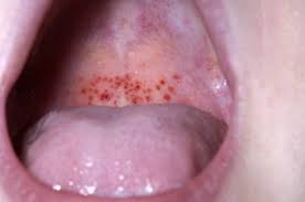 La piastrinopenia che indica piastrine basse è una condizione in cui vi è un numero inferiore di queste al minimo scoprine le cause e i sintomi. Panoramica Sulla Trombocitopenia Disturbi Del Sangue Manuale Msd Versione Per I Pazienti