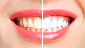 · close gaps between teeth without . Cosmetic Dentistry Edmonton Cosmetic Dentistry Near Me