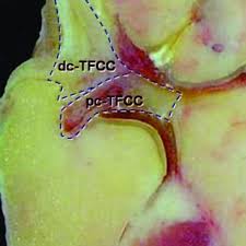 Zu einer ruptur der aorta kann es entweder durch fortschreitende veränderungen in der gefäßwand (z.b. Pdf New Trends In Arthroscopic Management Of Type 1 B Tfcc Injuries With Druj Instability