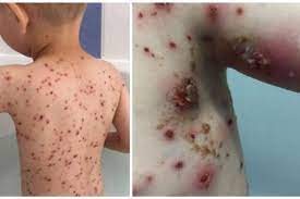 Utilizarea preparatelor naturale calivita pentru tratarea varsatului de vant. De Ce Nu Ar Trebui SÄƒ FoloseÈ™ti NiciodatÄƒ Ibuprofen Pentru A Trata Varicela Totul Despre Mame