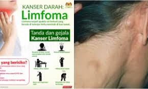 Bagi mereka yang masih belum mengetahui apa itu kanser kelenjar atau kanser limfoma, baca penjelasan dari pegawai perubatan ini dengan teliti agar tidak tersalah faham jika kelenjar pada badan anda bengkak. 5 Perkara Tentang Kanser Limfoma Yang Jarang Diketahui