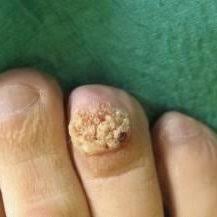 The tumors may present as spots, patches, masses that are either flat or raised. Case 2 Verrucous Carcinoma Of The Toe Download Scientific Diagram