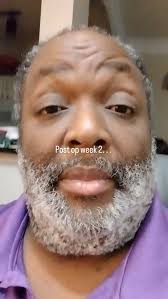 #stillstrappedin #ventralherniasurgery