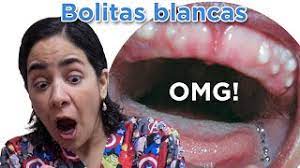 Mi Bebe Tiene Bolitas Blancas En La Encia Es Malo Youtube