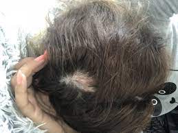 Delle Am Kopf Mit Haarausfall