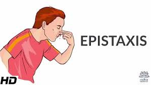 Image result for Epistaxis