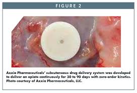 Advanced Delivery Devices Implantable Drug Eluting Devices A Novel Approach To Patient Care
