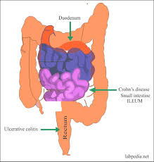 Knowing more about crohn's disease can help you to feel better informed and able to take a more active part in decisions about your treatment. Ulcerative Colitis And Crohn S Disease Labpedia Net
