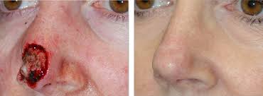 If you're getting ready to have lung surgery or know someone who is, understanding what the different procedures involve. Nasal Reconstruction For Skin Cancer Patients In Seattle Sattler Plastic Surgery Seattle