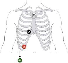 Ecg Lead Positioning Litfl Medical Blog Ecg Library Basics