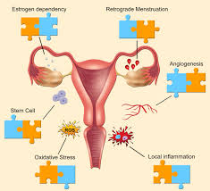 Endometriosis can be a challenging condition to manage. Endometriosis Current Challenges In Modeling A Multifactorial Disease Of Unknown Etiology Journal Of Translational Medicine Full Text