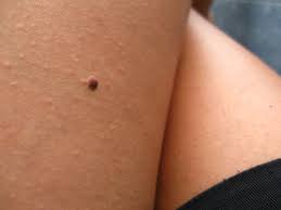 Diferentes instituciones como cancer.gov del national cancer institute, han agrupado las enrojecimiento de la piel (eritema). Sintomas Del Cancer De Piel Signos Picazon En La Cara Y Mucho Mas