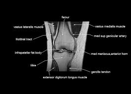 Quadriceps tendon semitendinosus tendonsemimembranosus muscle popliteal artery and vein biceps femoris femur vastus medialis sartorius muscle suprapatellar bursa. Knee Anatomy Mri Knee Coronal Anatomy Free Cross Sectional Anatomy