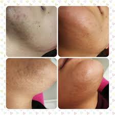 The new nono hair 8800 is the hottest concept in hair removal. Sangita S Laser And Beauty Clinic Laser Hair Removal Results Just After 2 Treatment Life Time Cost Saving More Esthetically Pleasing Say Goodbye To Ingrowing Hairs Red Dots And Shaving Rashes No