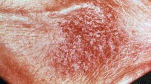 Image result for Neurodermatitis