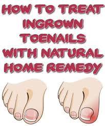 Treating Ingrown Toenails With Natural Home Remedy Treating Ingrown Ingrown Toe Nail Toe Nails