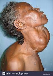 Adamsapfel — adamsapfel, lateinisch prominentia laryngea1, bezeichnet den vor allem bei männern hervorspringenden und tastbaren abschnitt des schildknorpels (cartilago thyroidea) des kehlkopfs. Patient Hat Ein Multinodularem Kropf Eine Schwellung Im Hals Knapp Unterhalb Der Adams Apfel Kehlkopf Durch Eine Vergrosserte Schilddruse Stockfotografie Alamy