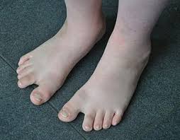 Down syndrome or down's syndrome, also known as trisomy 21, is a genetic disorder caused by the presence of all or part of a third copy of chromosome 21. Trisomie 21 Alles Uber Das Down Syndrom