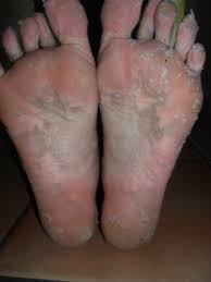 Although, we're not talking about those intense market peels that may grace your social media feeds, where users end up peeling off scales like a snake shedding its skin (strangely below, see how derms suggest pampering those soles with your own diy solution. A Diy Peel For Dry Cracked Feet Foot Peel Peeling Mask Dry Cracked Feet