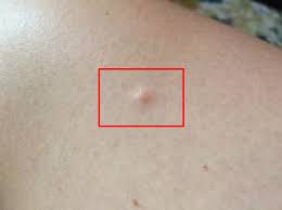 Чаще они локализуются в верхних конечностях, на туловище, лице. Uplotnenie Pod Kozhej V Vide Sharika Foto Prichiny Kak Lechit