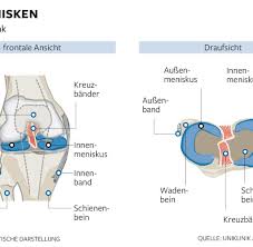 Knie Kaputten Meniskus Unbedingt Behandeln Lassen Welt