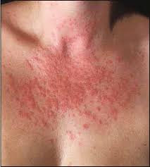 Image result for Photodermatitis