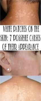 White Patches On The Skin 7 Possible Causes Of Their Appearance White Patches White Skin Patches Skin Disorders