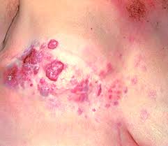 Metastasis is when cancer spreads to another part of the body from its original site. Pathology Outlines Metastatic