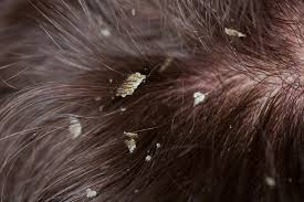 White buildup on the scalp comes down to one thing: 2 Fast Ways To Get Rid Of White Build Up On Scalp
