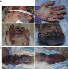 It presents as a purpuric rash and symmetric gangrene that often necessitates amputation. Presentation And Outcome Of Purpura Fulminans Associated With Peripheral Gangrene In 12 Patients At Mayo Clinic Journal Of The American Academy Of Dermatology