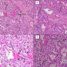 Pdf Hyaline Membrane Disease Hmd The Role Of The Perinatal Pathologist