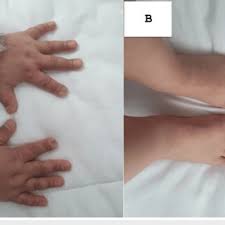 Image result for Koilonychia feet