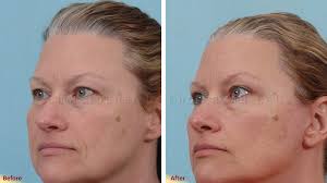 Blepharoplasty or Eyelid Surgery Photos