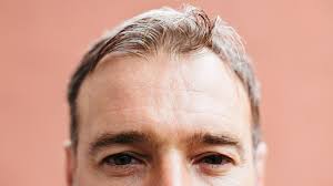 Well, it can raise androgen (male hormone) levels, which in turn can causes hair loss. Medications That Cause Hair Loss List What You Can Do And More