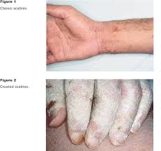 Image result for scabies norvegica