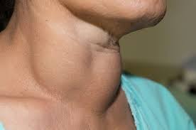 Learn about hyperthyroidism and its symptoms, causes, diagnosis, and treatment. Understand These Thyroid Symptoms For Diagnosis And Treatment