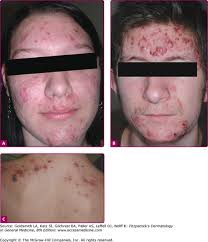 Maybe you would like to learn more about one of these? Acne Vulgaris And Acneiform Eruptions Plastic Surgery Key