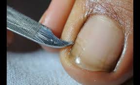 nail fungus the importance of early