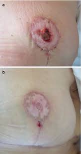 Genii ortopedii the genius of orthopaedics. Management Of Nipple Areolar Complex Complications In Nipple Sparing Mastectomy With Prosthetic Reconstruction Springerlink