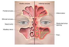 Sinus Infection (Sinusitis) | Antibiotic Use | Cdc