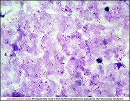  thick and thin blood smears stained with giemsa stain remain the 'gold standard'. Plasmodium Falciparum Cell Atlas Of Haematological Cytology