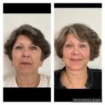 Brow/Forehead Lift Albuquerque NM, D. Eric Tuggle, D.D.S.